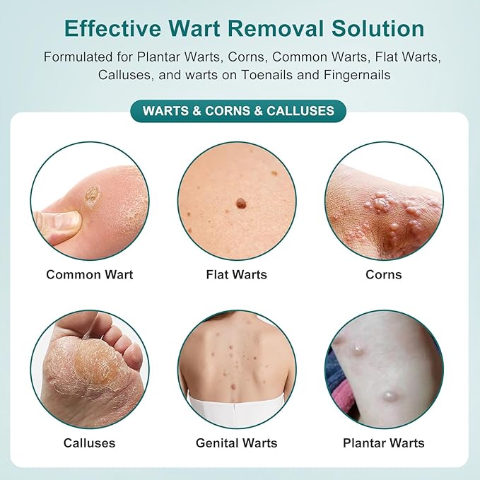 Tag Removal Wart Remover Fast Acting Gel – Maximum Strength Freeze Off Ointmen Fast Acting Natural Common Wart Removal for Plantar,Genital,H (Green-b, S)